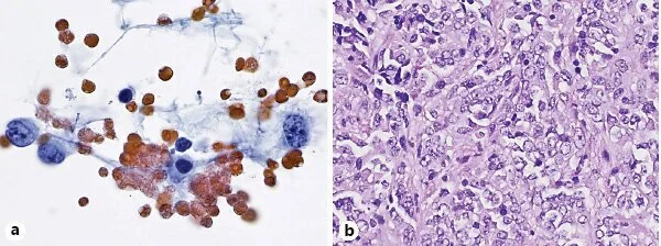 Assessment of the Utility of Cytology and Flow Cytometry of Cerebrospinal Fluid Samples in Clinical Practice