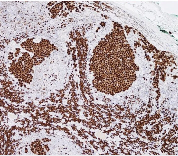 An intrasinusoidal extracavitary variant of primary effusion lymphoma